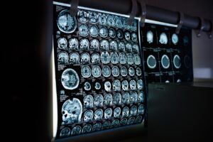 New Parkinson Leitlinie der DGN