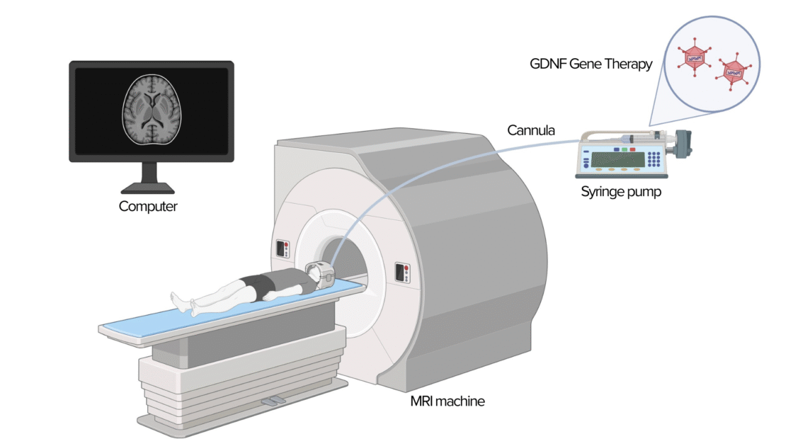 MRT-gestützte Verabreichung einer GDNF-Gentherapie bei Parkinson: Eine Kanüle infundiert das Therapeutikum mithilfe einer Spritzenpumpe präzise in das Gehirn.