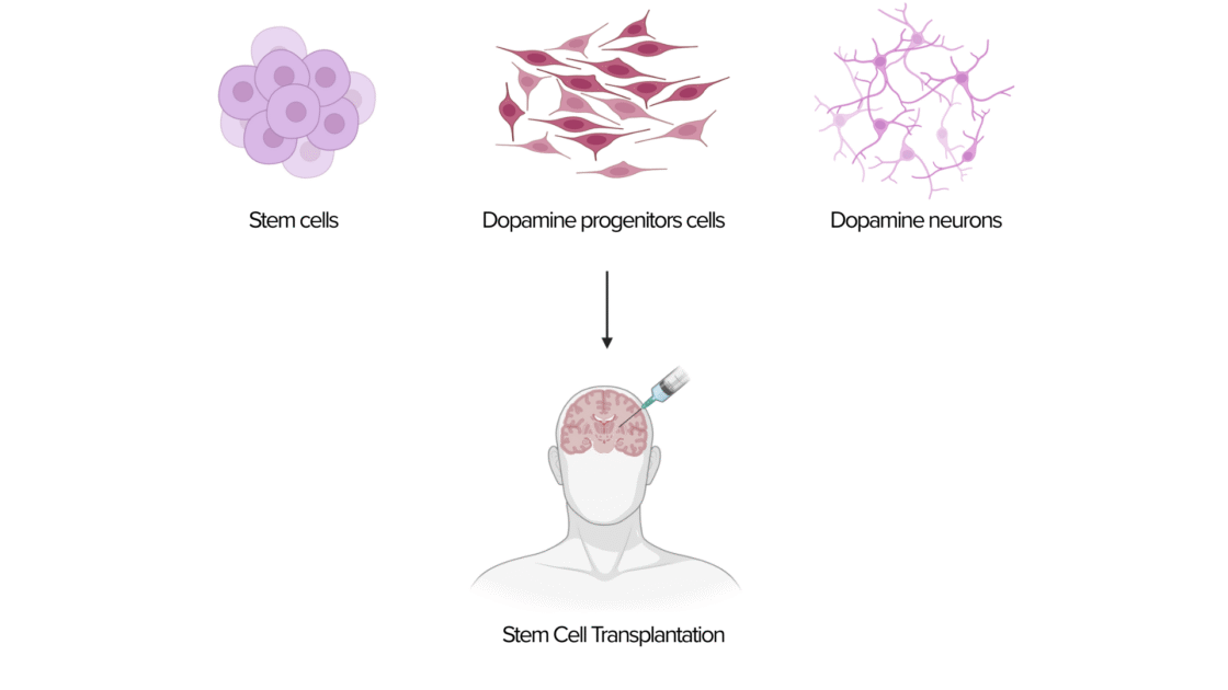 Schema der Stammzelltherapie bei Parkinson: Aus Stammzellen abgeleitete Dopamin-Progenitorzellen entwickeln sich zu Dopaminneuronen und werden ins Gehirn transplantiert.